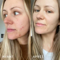 Microbiote & Peau 7 Microbiote & Peau -Beaute Luxe Soldes AVANT APRES LAURA.1.4jpg
